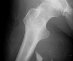 Image: fracture