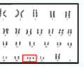 Image: trisomy