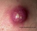 Image: abscess
