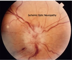 Image: anterior ischemic optic neuropathy (AION)