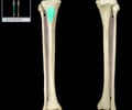 Image: tibial tuberosity