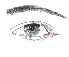 Image: lateral canthus