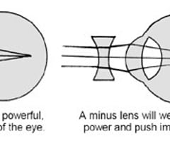 Image: myopia