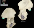 Image: Posterior inferior iliac spine