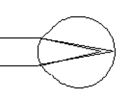 Image: Simple myopic astigmatism