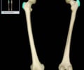 Image: greater trochanter