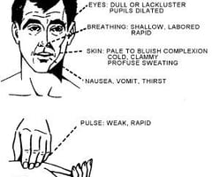 Image: symptoms of shock