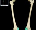 Image: Medial condyle of femur