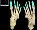 Image: Phalanges of the foot