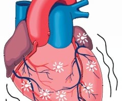 Image: cardiac arrest