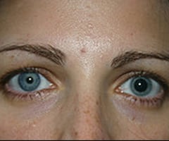 Image: anisocoria