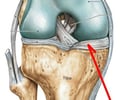 Image: medial meniscus