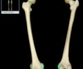 Image: Medial epicondyle of femur