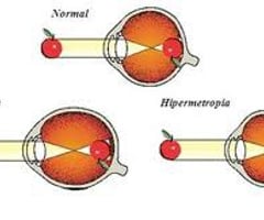 Image: ametropia
