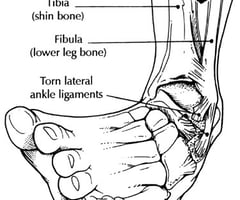 Image: sprain