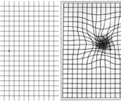 Image: Amsler grid test