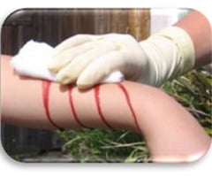 Image: external bleeding