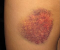 Image: closed wound