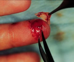 Image: avulsions