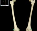 Image: Lateral epicondyle of femur