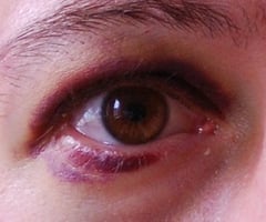 Image: contusions