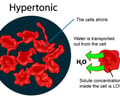 Image: Hypertonic