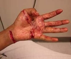 Image: open wound