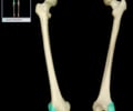 Image: Lateral condyle of Femur
