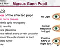 Image: afferent pupillary defect (APD) ( Marcus Gunn Pupil )