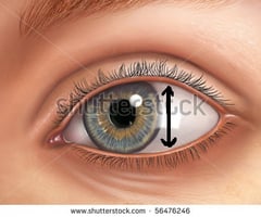 Image: palpebral fissure