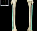 Image: shaft of fibula
