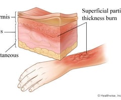 Image: second degree burns