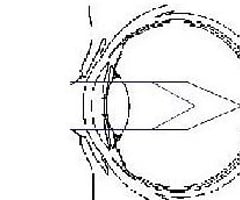 Image: Compound myopic astigmatism