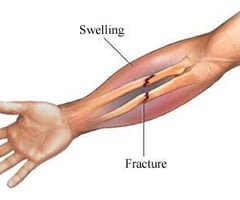 Image: closed fracture