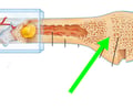 Image: epiphyseal line