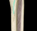 Image: soleal line (popliteal line)