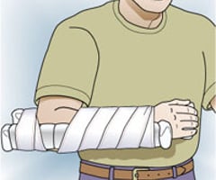 Image: applying a splint