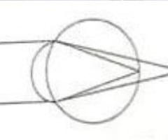 Image: Simple hyperopic astigmatism