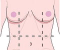 Image: left inguigal/iliac region
