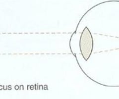 Image: emmetropia