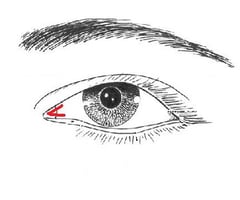 Image: medial canthus
