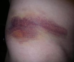 Image: internal bleeding