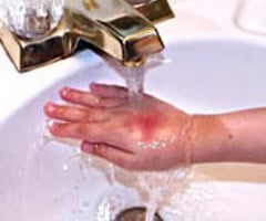 Image: treating first degree burns