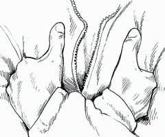 Image: treatment of frostbite