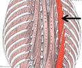 Image: Erector Spinae-Ilioscostalis