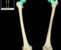 Image: Neck of femur