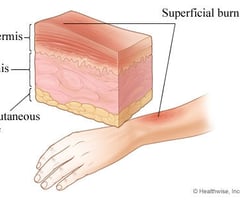 Image: first degree burns
