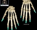 Image: distal