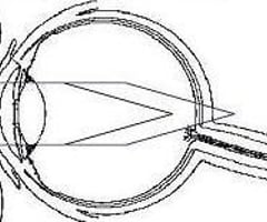 Image: Mixed astigmatism