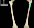Image: Gluteal tuberosity of femur